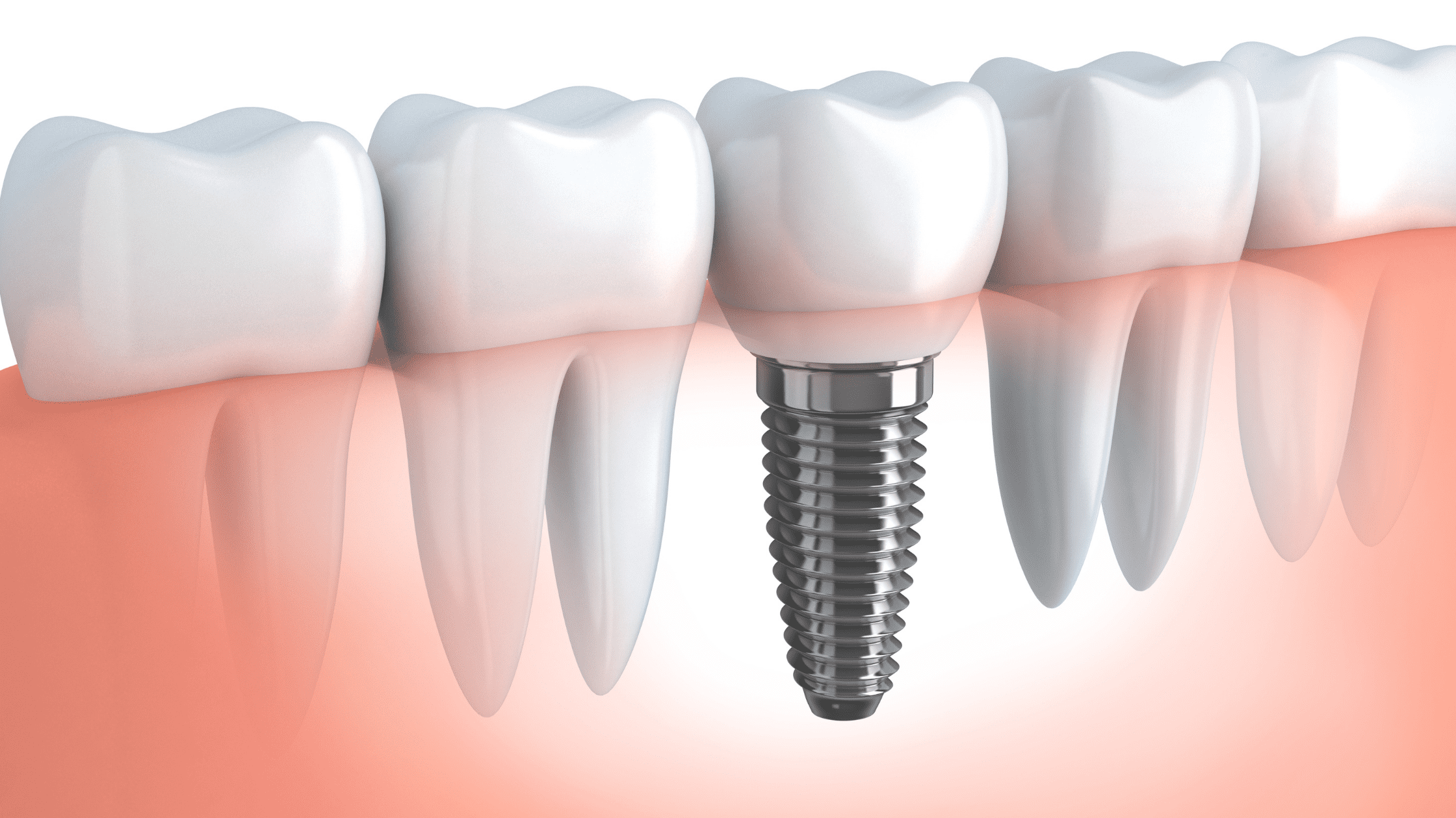 dental implants
