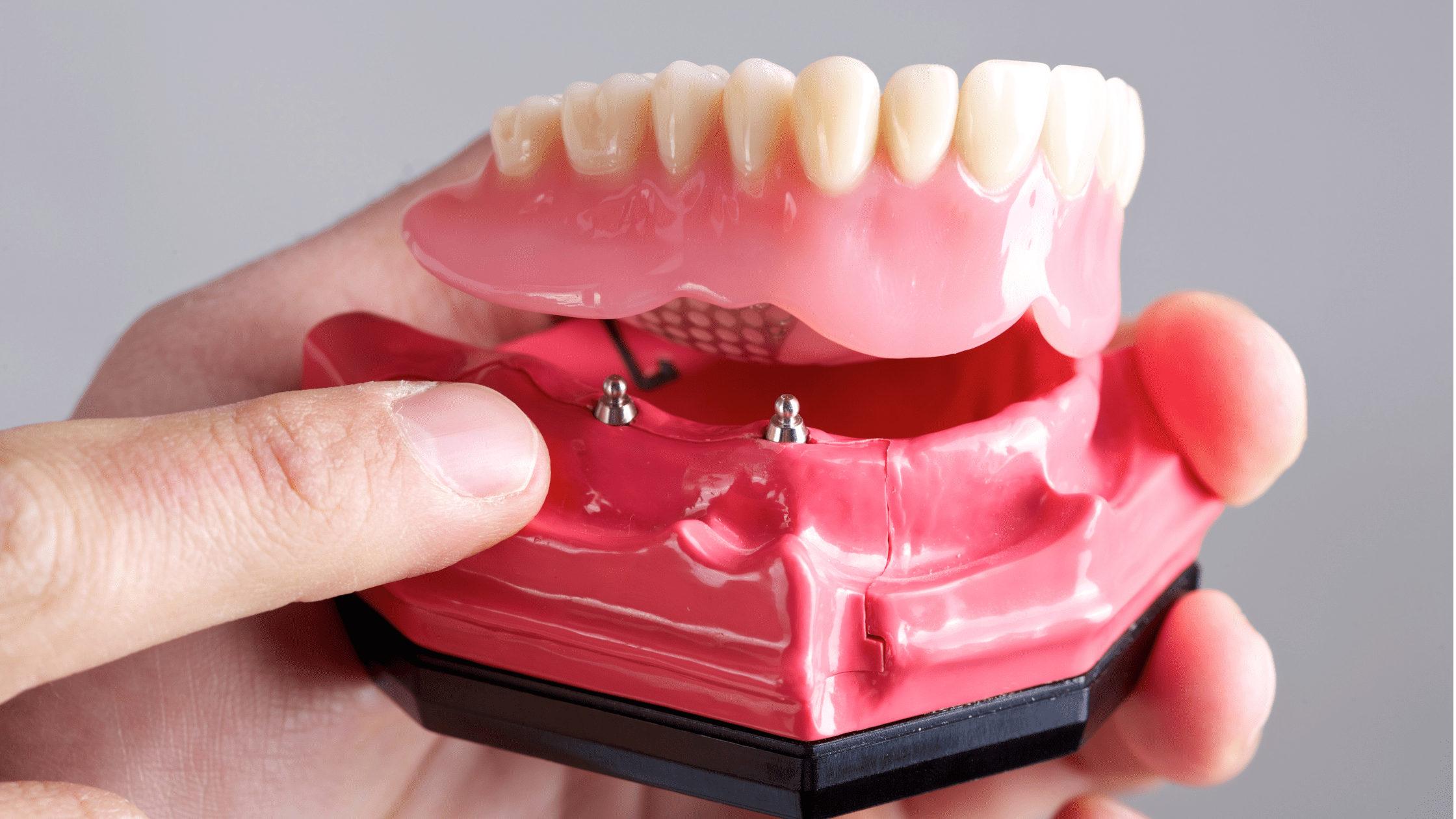 implant supported denture
