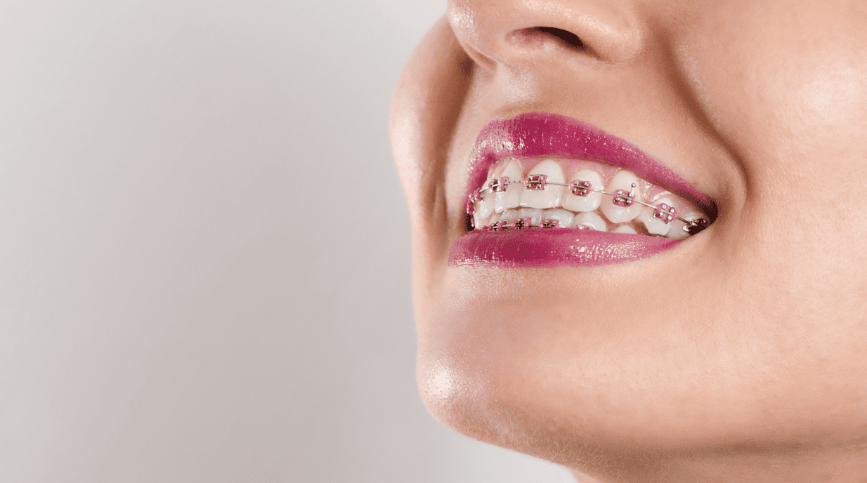 braces cost in the lower mainland