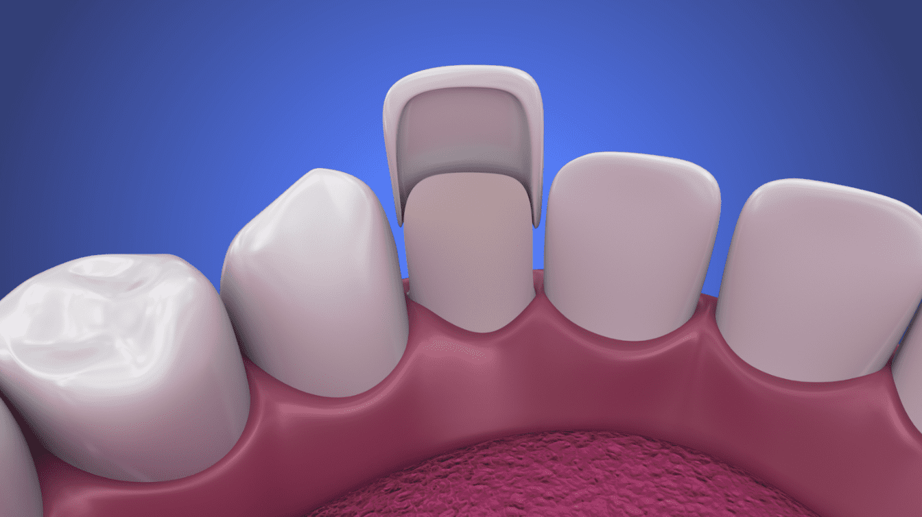 veneers