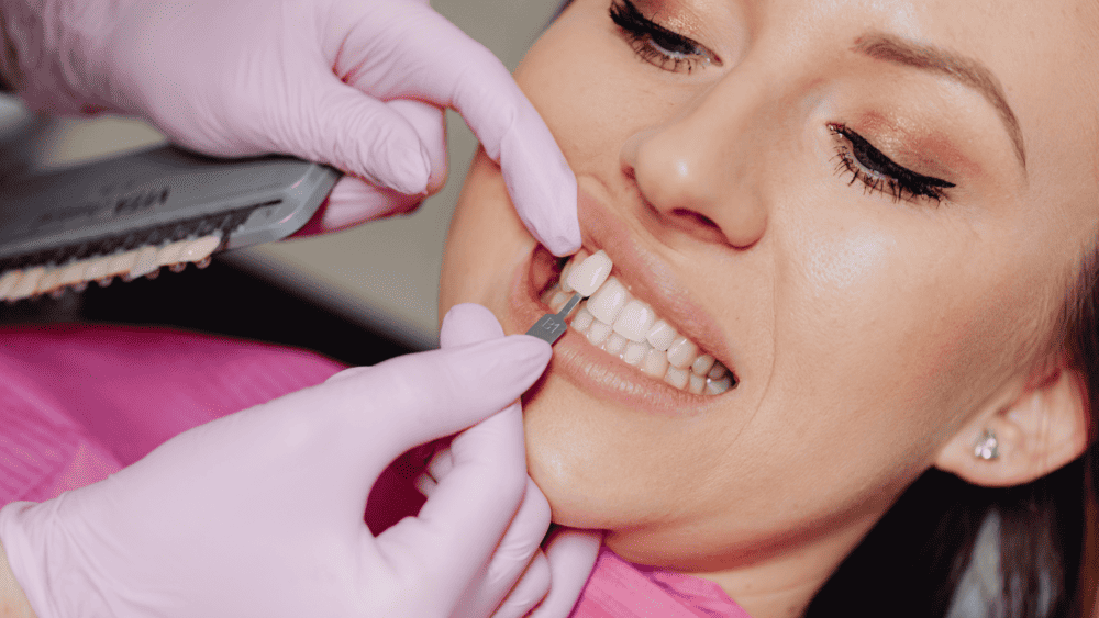 veneers